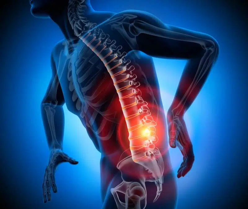 Heatmap of a man with spinal discomfort